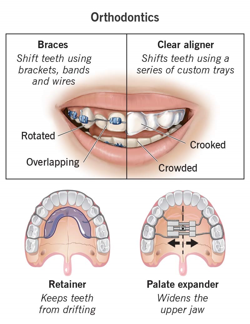 4 Types of Orthodontic Treatments Procedures Sunrise Dental