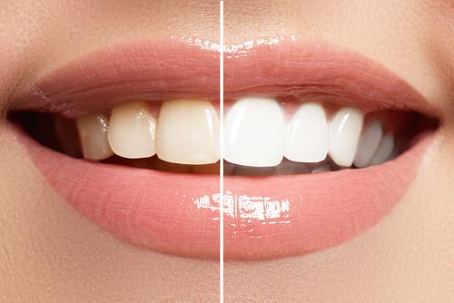 5 Natural Ways To Whiten Your Teeth