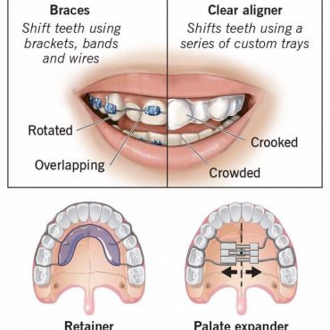 Educational infographic showing different orthodontic treatments and their functions