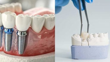 Dental Implants vs Bridges