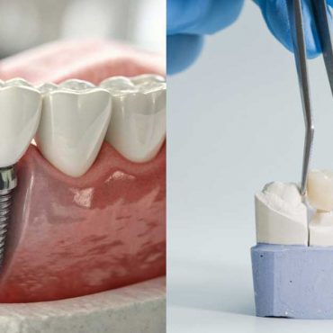 Dental Implants vs Bridges