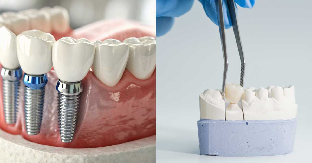 Dental Implants vs Bridges