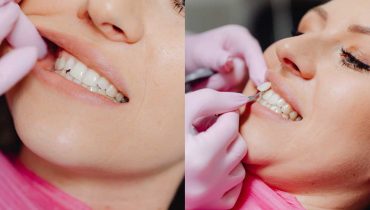 Teeth Whitening vs Veneers
