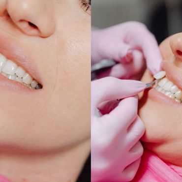 Teeth Whitening vs Veneers