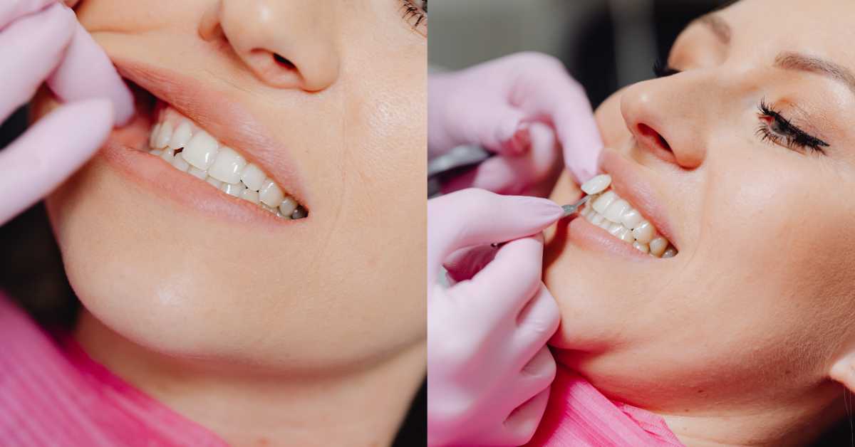 Teeth Whitening vs Veneers
