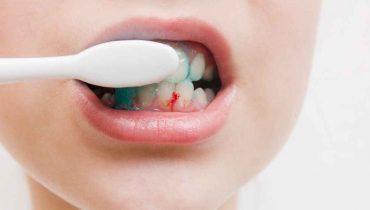 Why Do My Gums Bleed When Brushing? Causes & Solutions