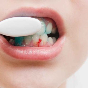 Why Do My Gums Bleed When Brushing? Causes & Solutions