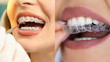 Braces vs Clear Aligners Cost in Australia