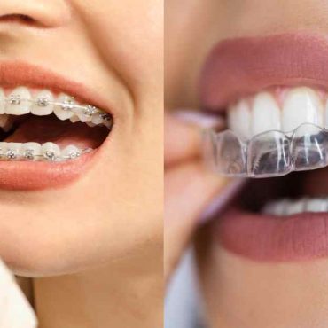 Braces vs Clear Aligners Cost in Australia