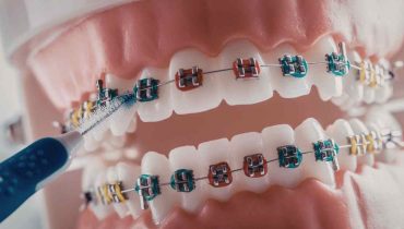 How 3D Dental Models Are Used in Modern Dental Treatments