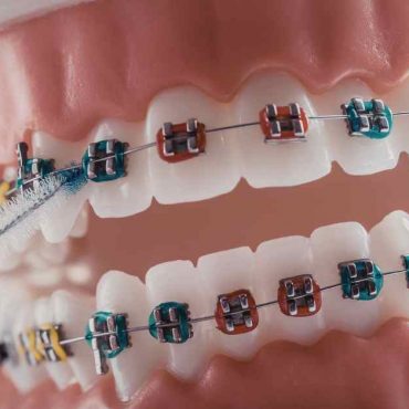 How 3D Dental Models Are Used in Modern Dental Treatments