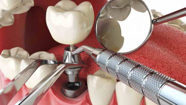 How Digital Technology Improves Dental Implant Accuracy