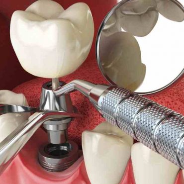 How Digital Technology Improves Dental Implant Accuracy
