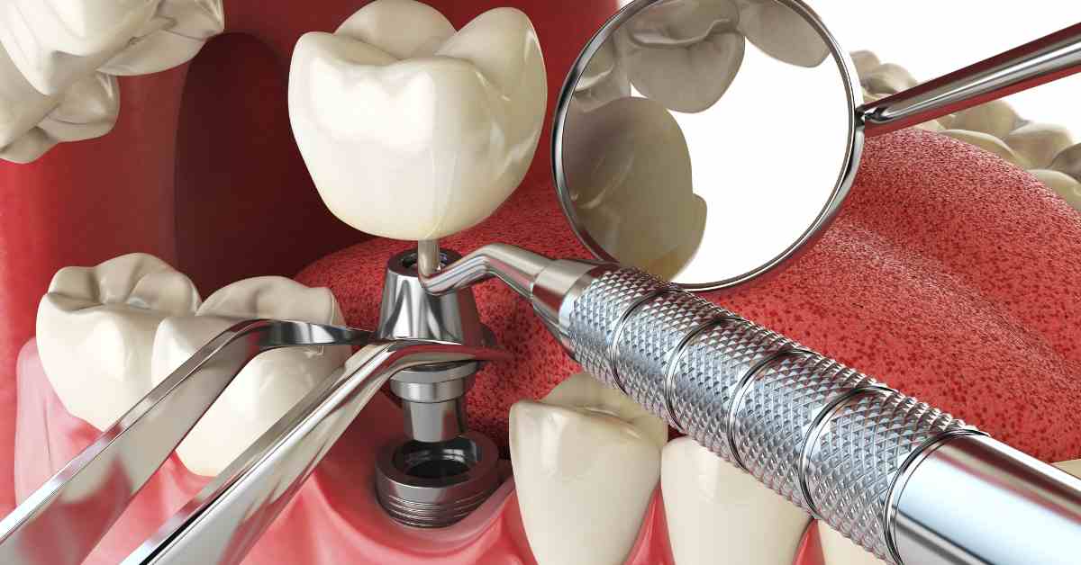 How Digital Technology Improves Dental Implant Accuracy