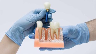 The Digital Workflow Behind Modern Dental Implants