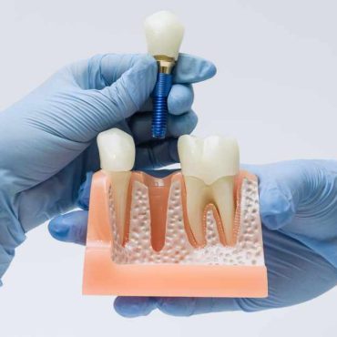 The Digital Workflow Behind Modern Dental Implants