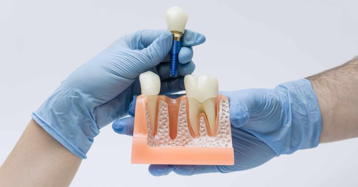 The Digital Workflow Behind Modern Dental Implants